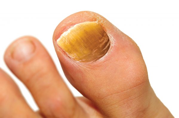Nail changes - local disorder or systemic disease?